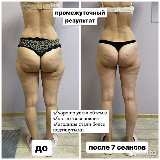 Антицеллюлитный массаж/ оздоровительный