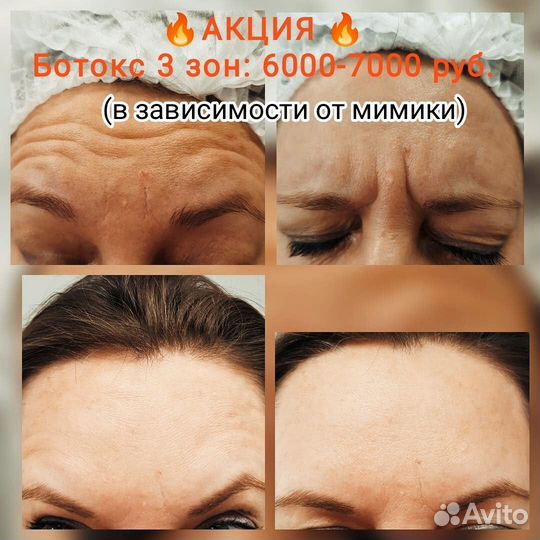 Увеличение губ