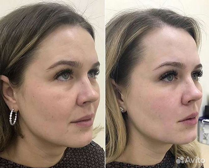 Аппаратное Омоложение лица