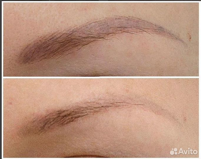 Осветление/ удаление тату/татуажа