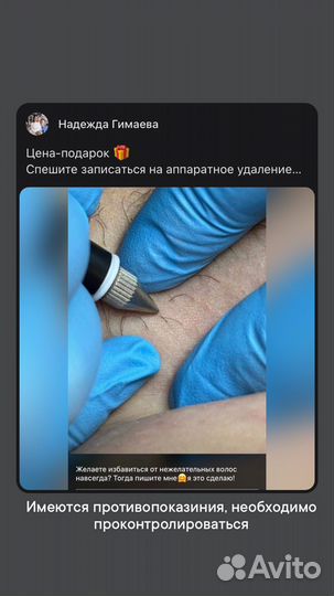 Электроэпиляция