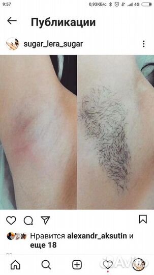 Шугаринг