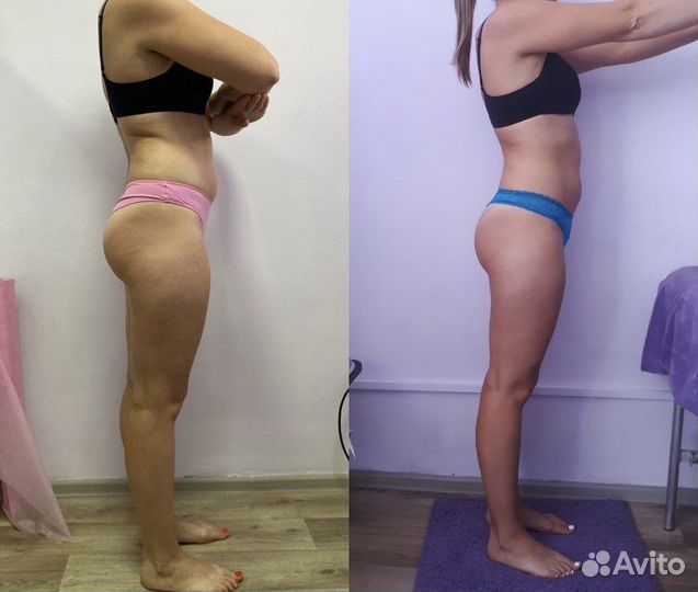 LPG массаж на аппарате B-Flexy