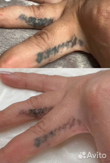 Удаление перманентного макияжа лазером