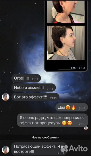 Rf лифтинг лица