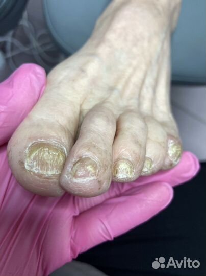 Подолог Елец Медицинский педикюр