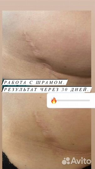 Холодная плазма