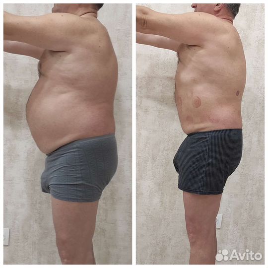 Антицеллюлитный и коррекция фигуры массаж