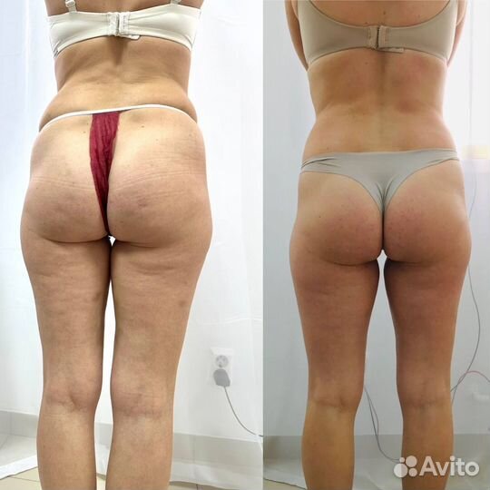 Аппаратный массаж RSL скульптурирование