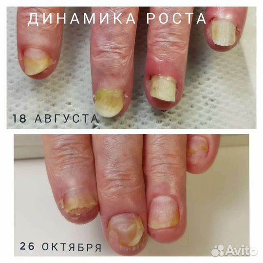 Подолог, педикюр, вросший ноготь, титановая нить