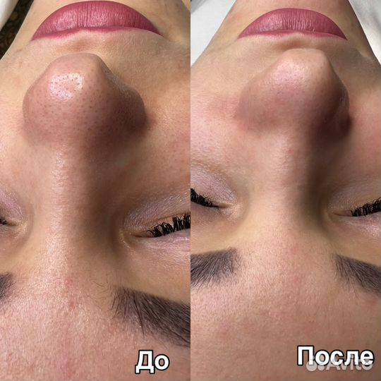 Косметолог/чистка лица/пилинг