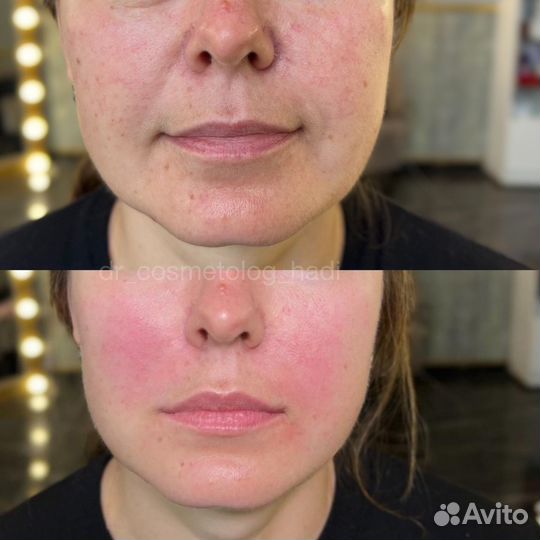 Коррекция носогубных складок