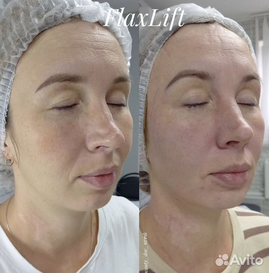 Косметолог без иголок