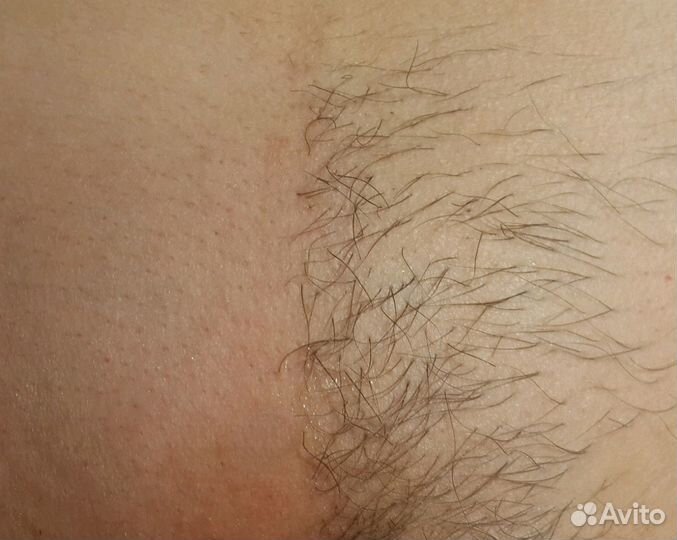 Депиляция сахарной пастой (шугаринг)