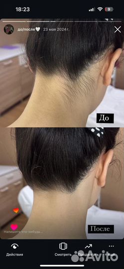 Лазерный аппарат сопрано