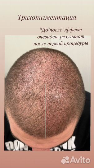 Камуфляж растяжек, удаление шрамов