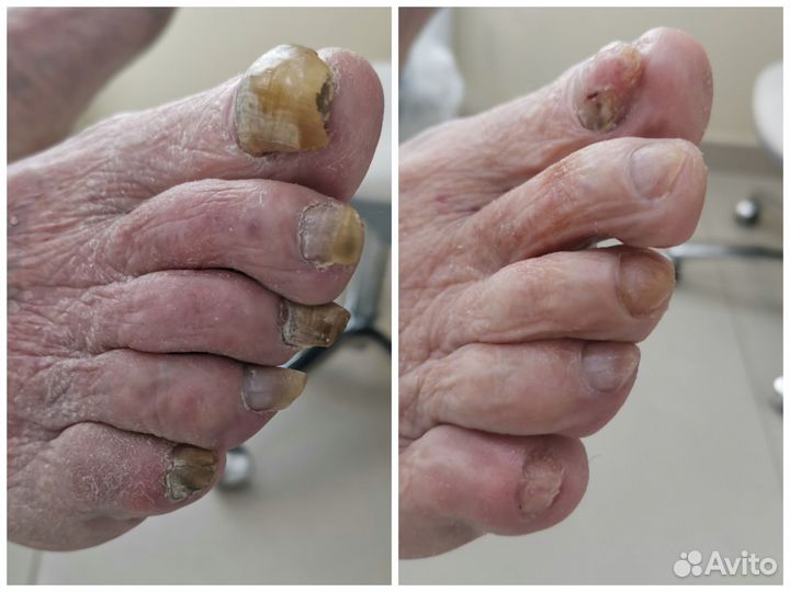 Подолог. Педикюр(грибок,вросший ноготь и др)