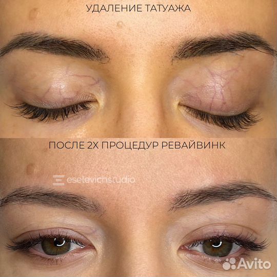 Удаление татуажа