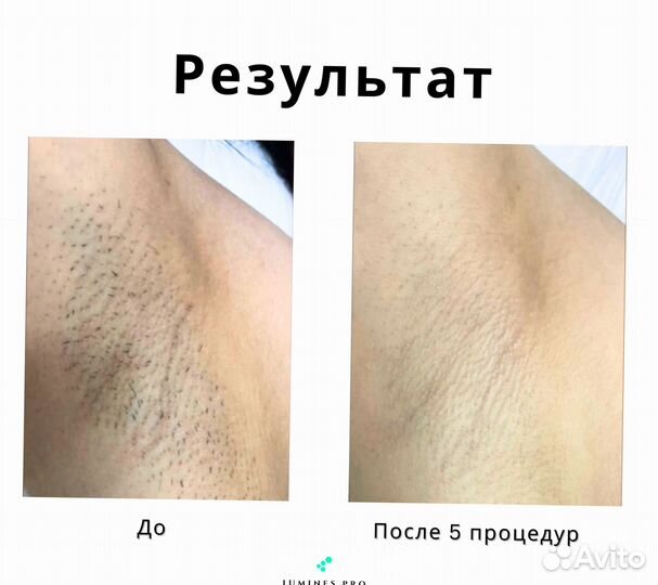 Аппарат для эпиляции Lumines. Макс’Ван 1200 Вт