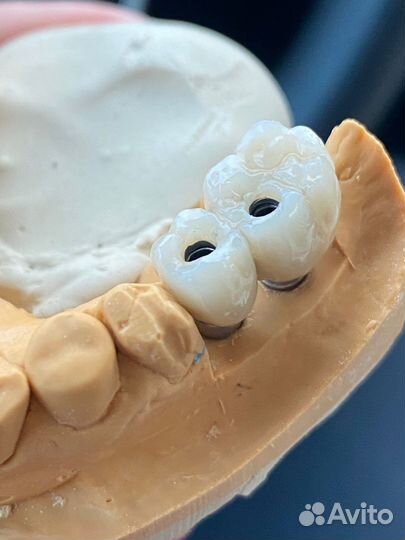 Коронки зубные изготовление