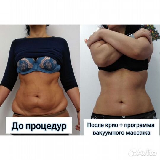 Криолиполиз Массаж Кавитация (коррекция фигуры)
