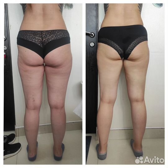 Антицеллюлитный массаж