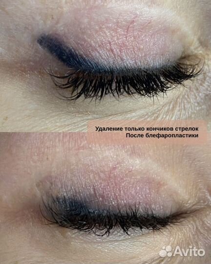 Удаление татуажа Брови/губы/стрелки Лучший Лазер