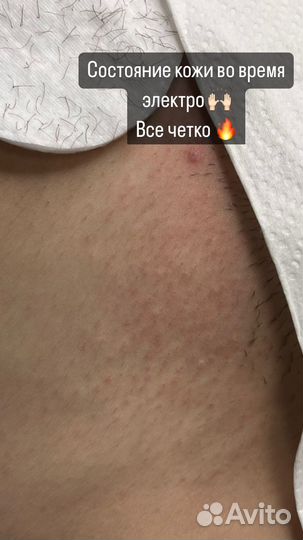 Электроэпиляция