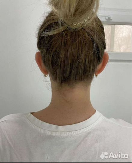 Отопластика нитевая