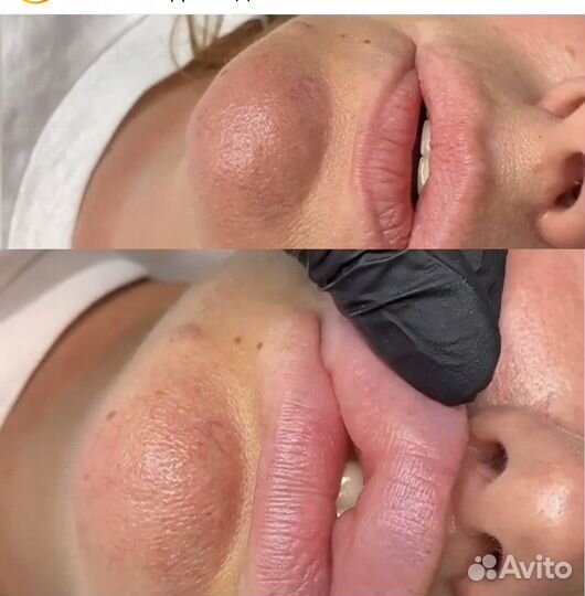 Удаление филлера