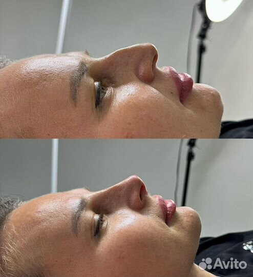 Коррекция носа филлером