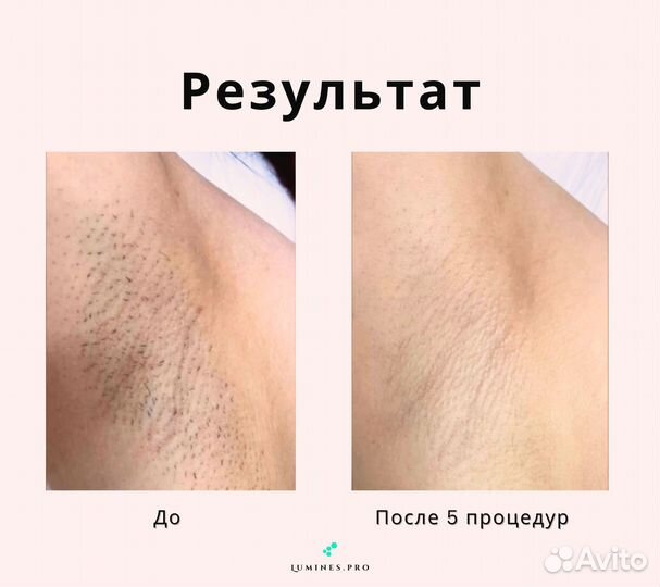 Диодный лазер для эпиляции Люминес’ максван 1200в