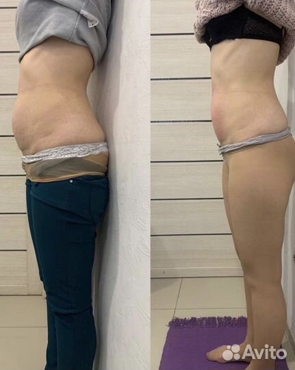 Аппаратная коррекция фигуры