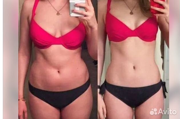 Удаление жира, криолиполиз в Перми