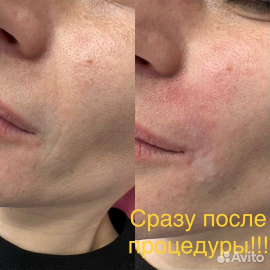 Лечение гипергидроза подмышек