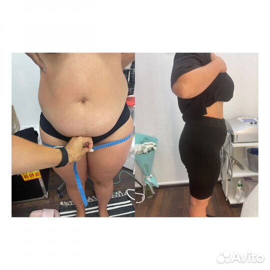 LPG массаж Антицеллюлитный