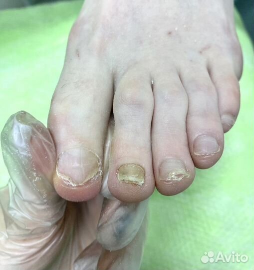 Медицинский педикюр подолог титановая нить