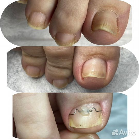 Вросший ноготь Подолог Педикюр