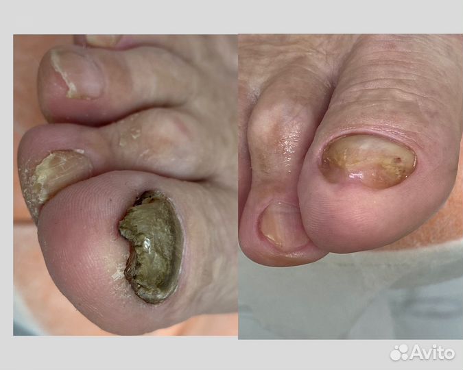 Педикюр подолог