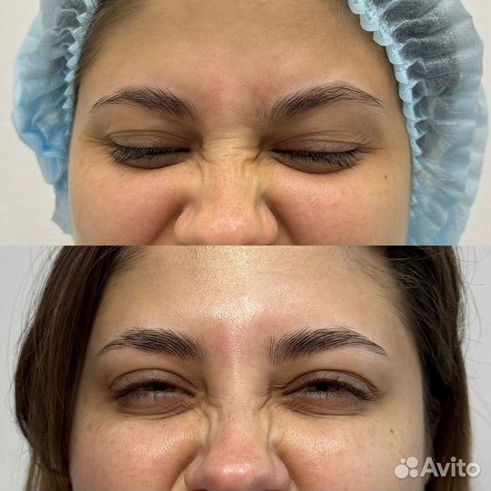 Ботулинотерапия