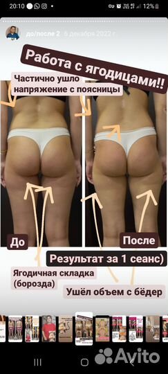 Антицеллюлитный массаж