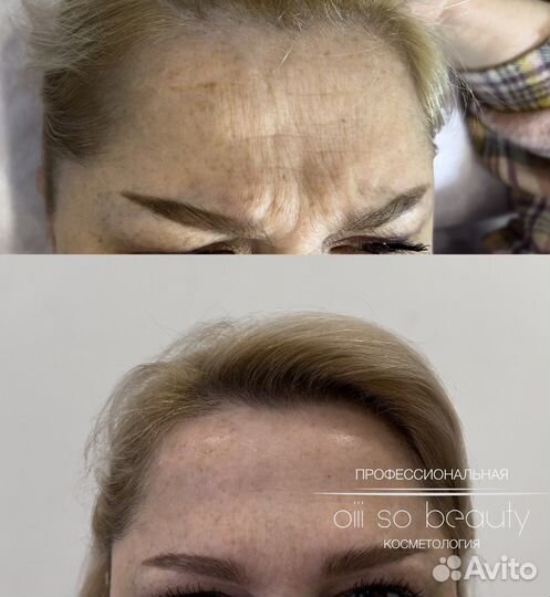 Ботокс для лица