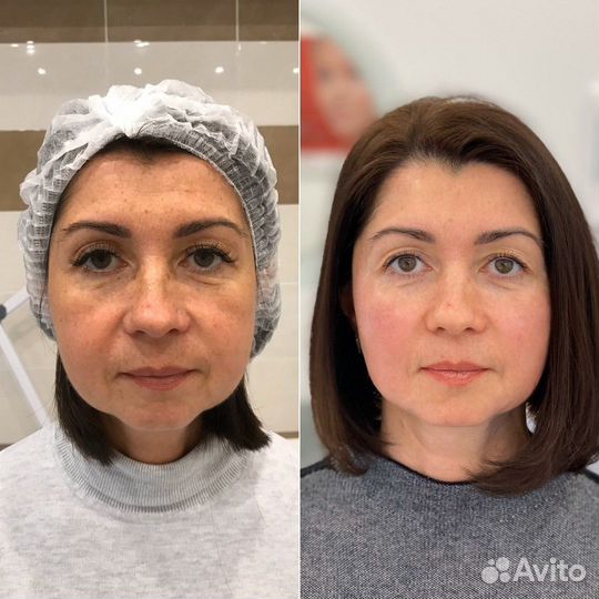 Векторный лифтинг лица