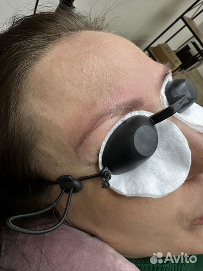 Удаление татуажа и тату лазером / ремувером