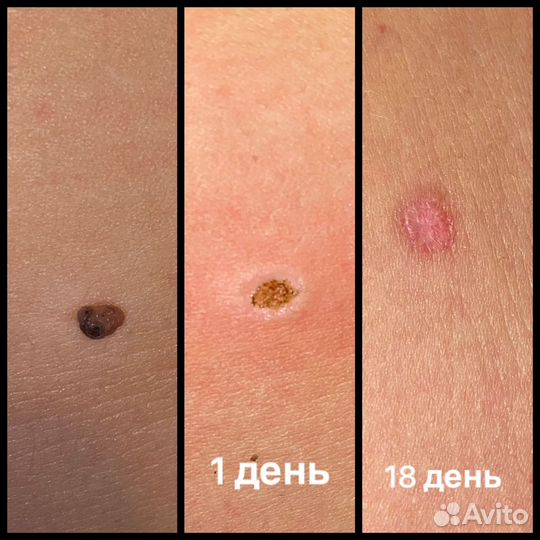 Удаление папиллом