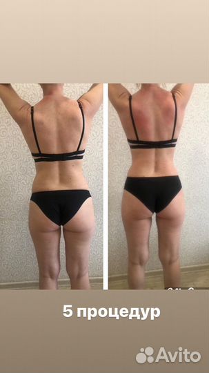 Антицеллюлитный массаж коррекция фигуры