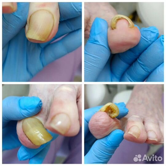 Педикюр аппаратный.парамедицинский