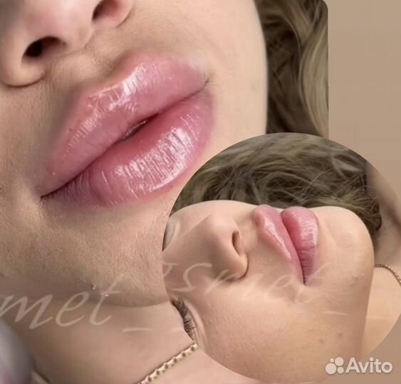 Увеличение губ, удаление филлера из губ