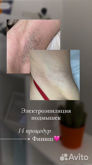 Модели на электроэпиляцию