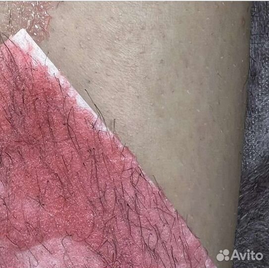 Депиляция воском: глубокое бикини